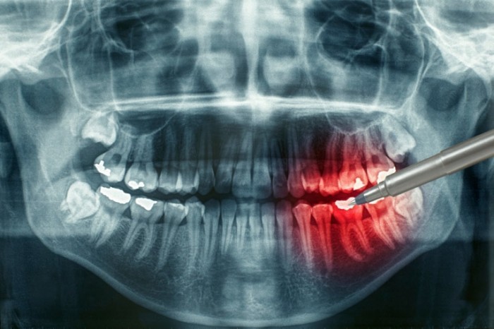 photodune 1933836 700x466 Рентген зубов   Dental xray